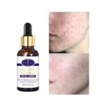 سرم صورت سفید کننده و ضد آکنه Aichun Beauty Onkessy Face Serum Fade Scar Essence - Image 7