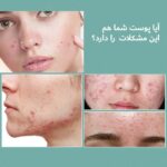 ژل ضدجوش لانبنا 20گرم - Image 4