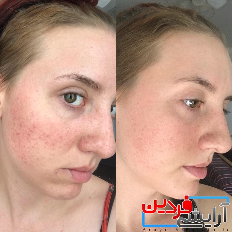 23c59d سرم ضد چروک رتینول 0.2% اوردینری حجم 30 میلی لیتر - Image 4