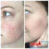 سرم ضد چروک رتینول 0.2% اوردینری حجم 30 میلی لیتر - Image 3
